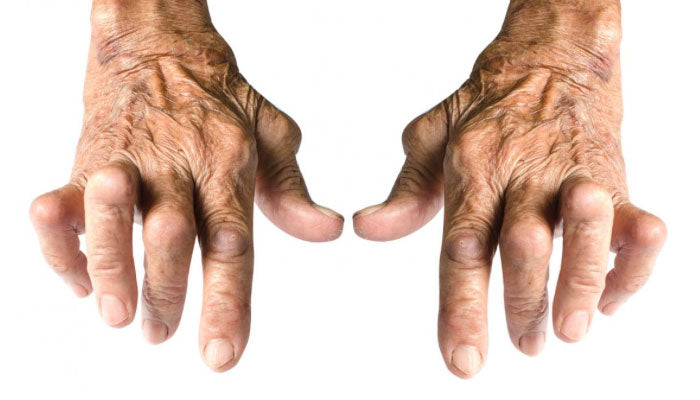 arthritic hands