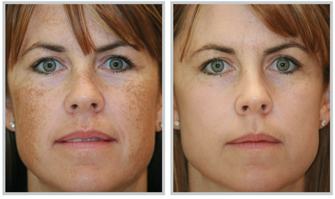 Treatment of Melasma on Face