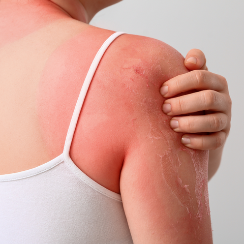 What causes Sunburns and how to heal it?