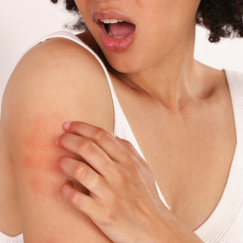Eczema Type: What is Irritant Contact Dermatitis?