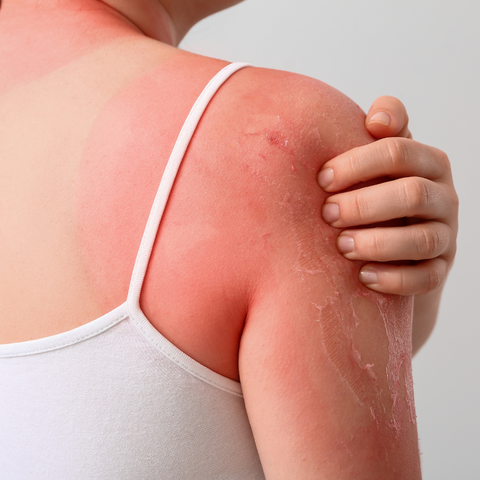 Eczema Type: What is Light Sensitive Dermatitis?