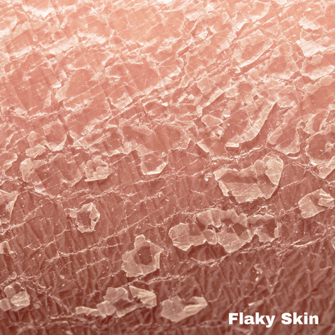 Sensitive Skin: Dry/Flaky Skin