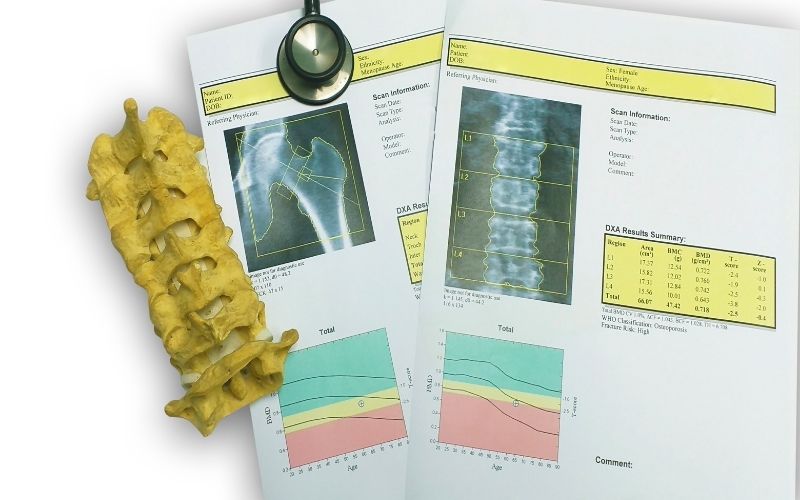 Bone density result with bone and stethoscope