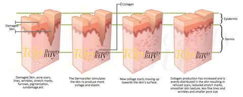 micro needling 