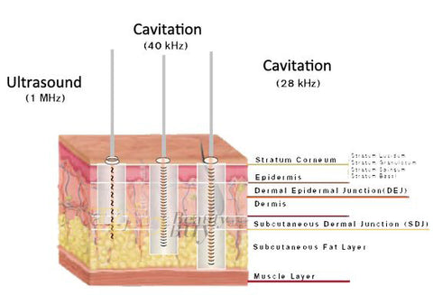 Ultrasonic Cavitation