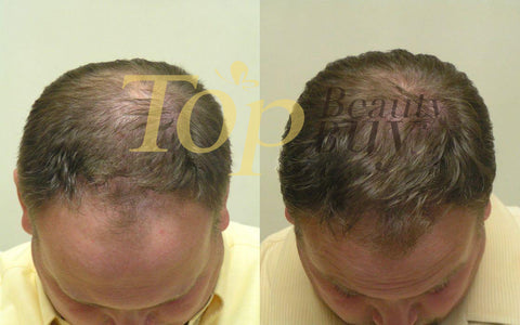 hair loss treatment before and after