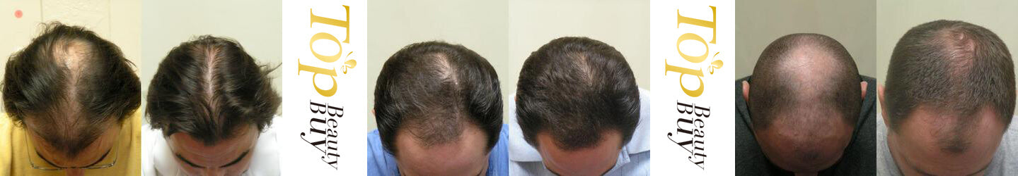 laser hair regrowth before and after