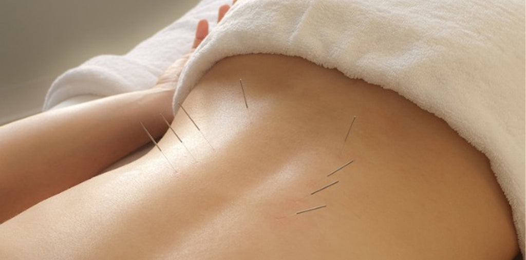 Traditional Chinese Medicine and Acupuncture