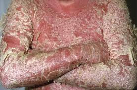 psoriasis guttate