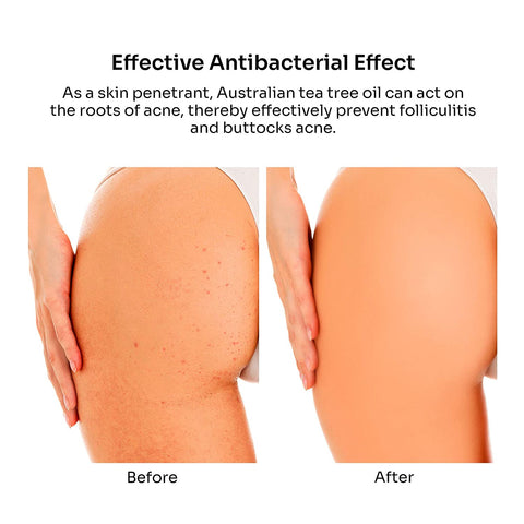 BellamiLuxx Butt Acne Clearing Lotion Antibacterial Effect: As a skin penetrant, Australian tea tree oil can act on the roots of acne, thereby effectively prevent folliculitis and buttocks acne