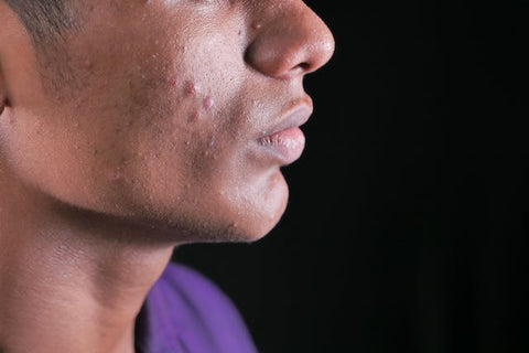 A man with acne breakout on his face