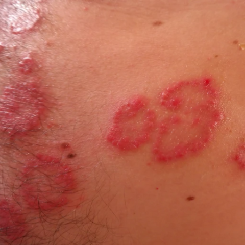 psoriasis on skin how it looks like