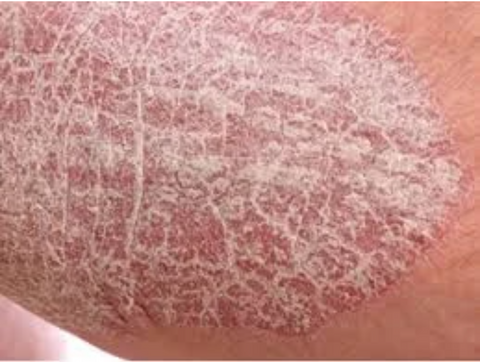 Psoriasis vs eczema