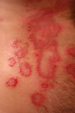 What causes psoriasis on scalp