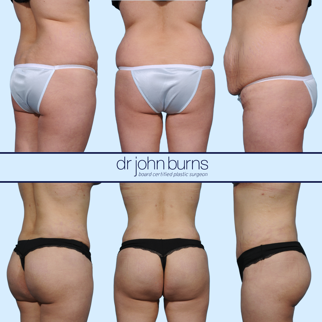 Before and after BBL and tummy tuck by Dallas plastic surgeon, Dr. John Burns