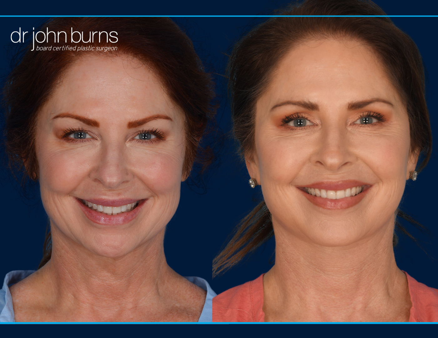 Facelift before and after by Dr. John Burns MD- Dallas Plastic Surgeon