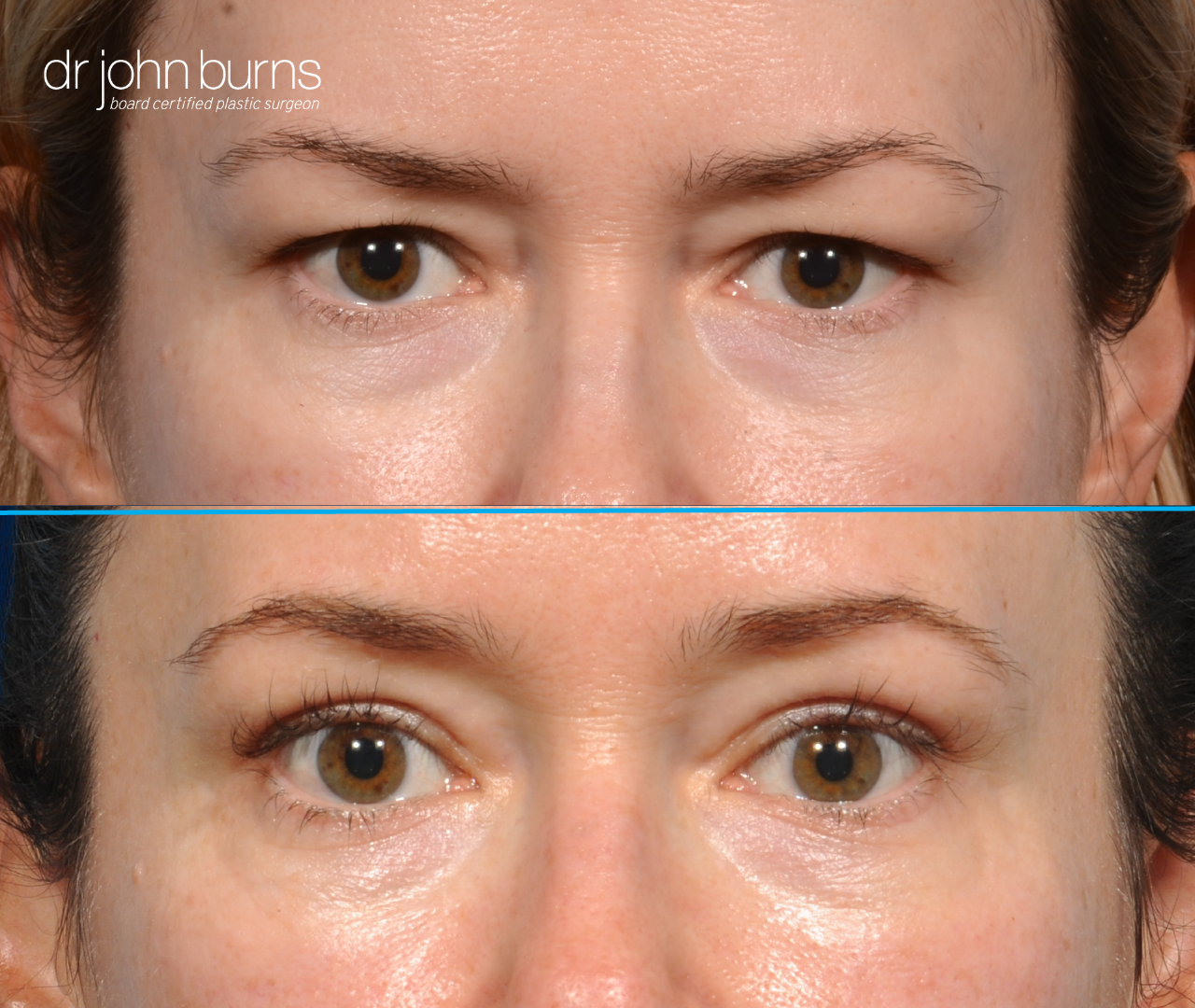 Upper eyelid before and after by Dr. John Burns