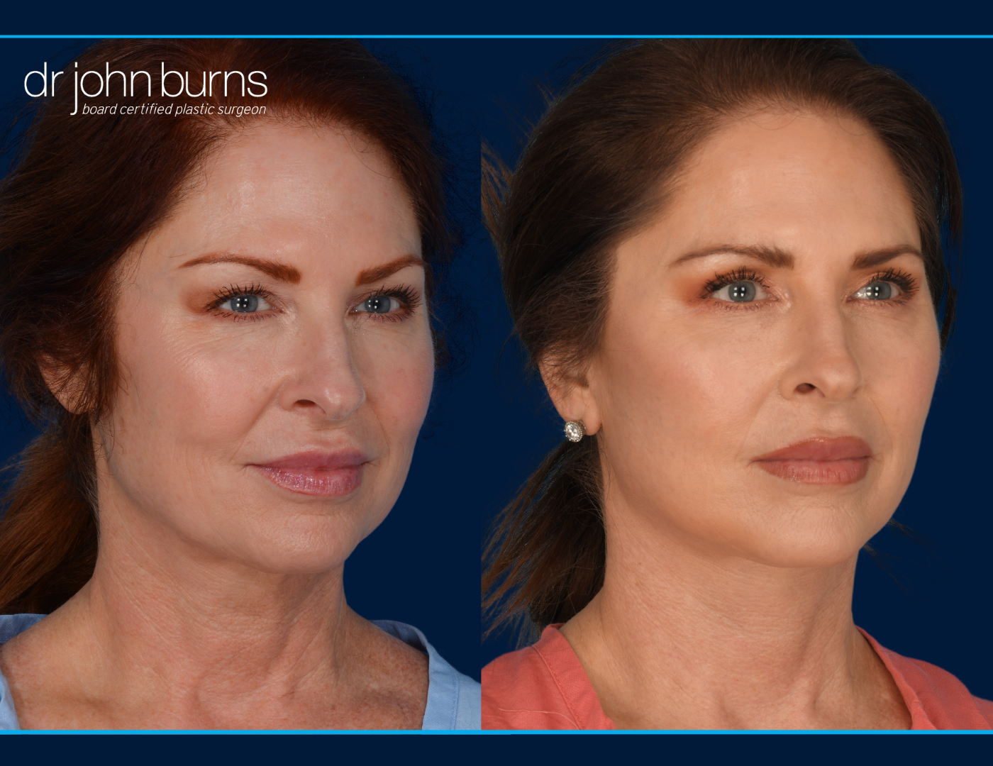 Facelift before and after by Dr. John Burns MD- Dallas Plastic Surgeon