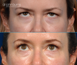 before and after eyelid surgery by dallas plastic surgeon, Dr. John Burn