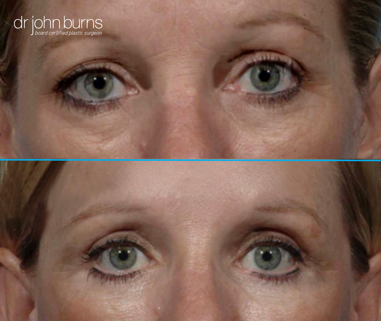 Upper eyelid before and after by Dr. John Burns