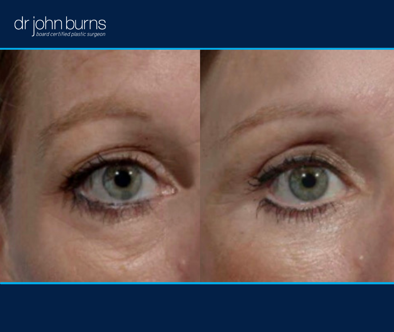 right eye view | before and after eyelid surgery results by Dr. John Burns