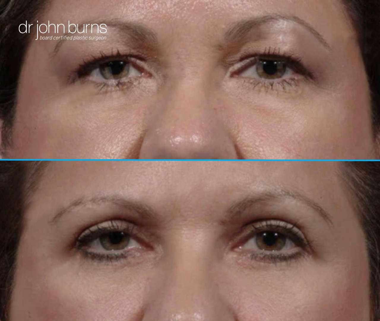 Upper eyelid before and after by Dr. John Burns