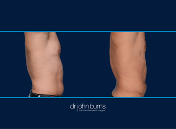 Right Profile View | Before and After Male Liposuction | Dallas, Liposuction