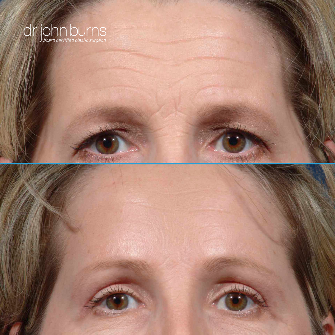 Brow lift before and after in Dallas, Texas