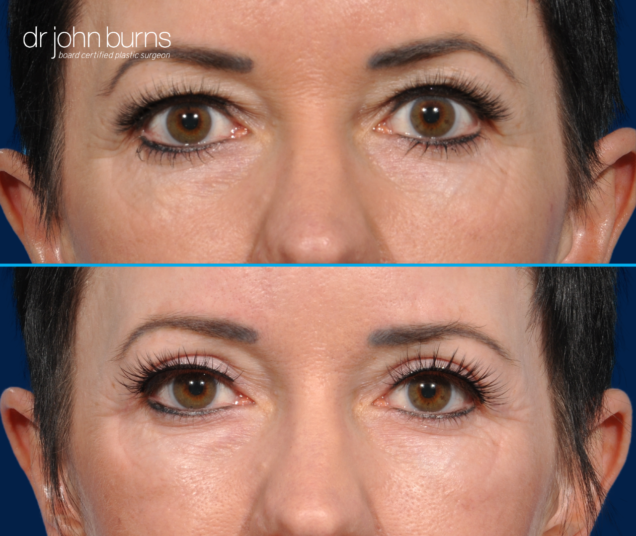 Upper eyelid before and after by Dr. John Burns