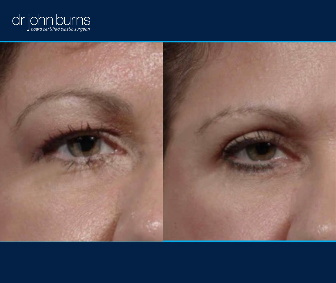 right eye view | before and after eyelid surgery results by Dr. John Burns