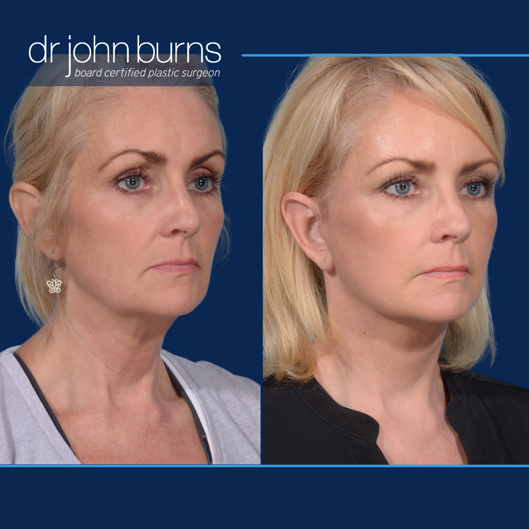Before and after mini deep plane facelift by Dallas plastic surgeon, Dr. John Burns