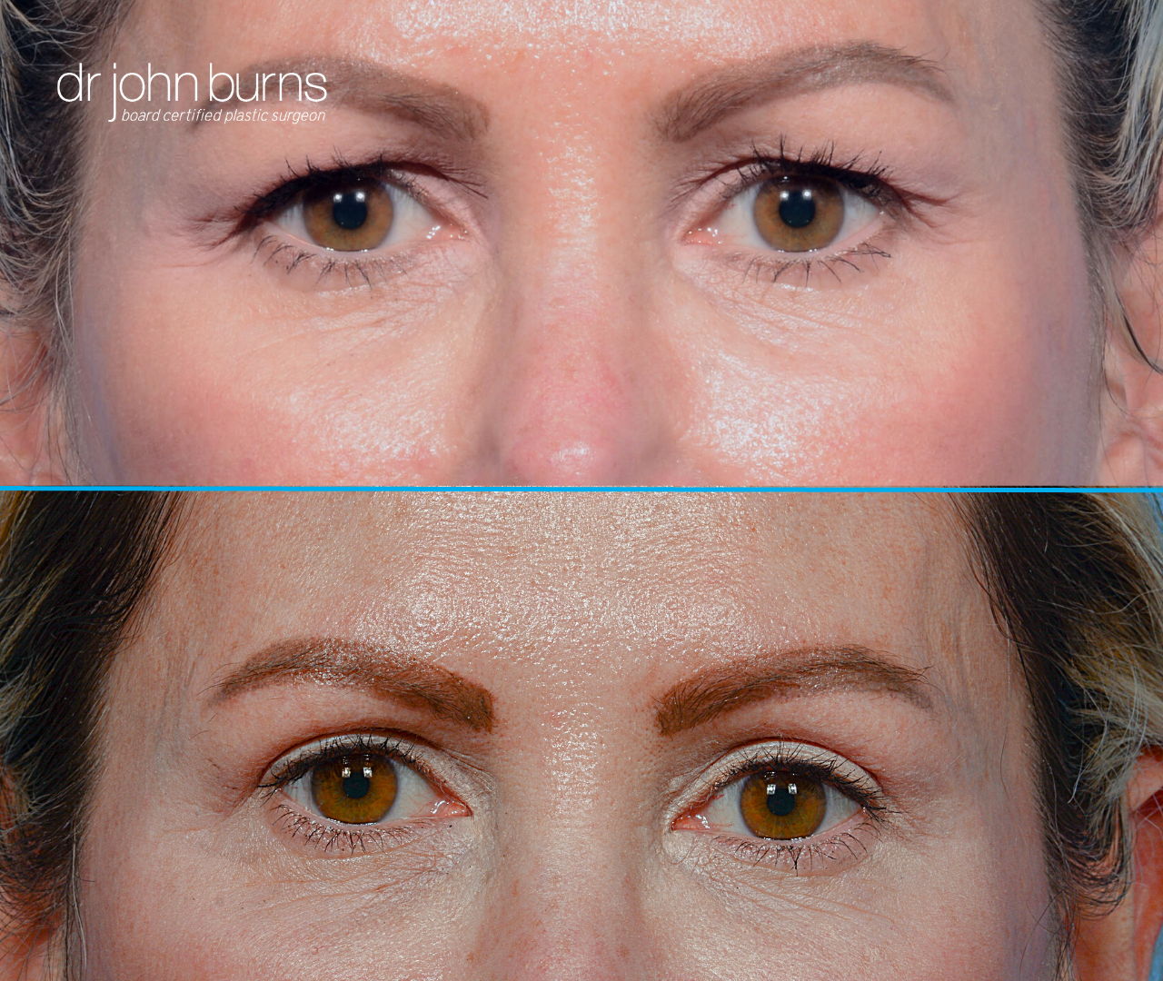 Upper eyelid before and after by Dr. John Burns