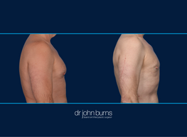 Right profile View | Before and After Male Chest Liposuction | Dallas, Liposuction