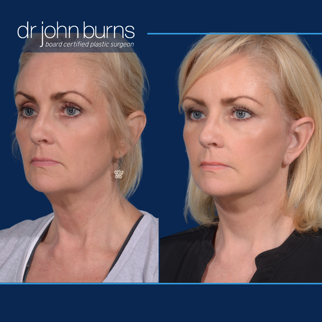 Before and after mini deep plane facelift by Dallas plastic surgeon, Dr. John Burns