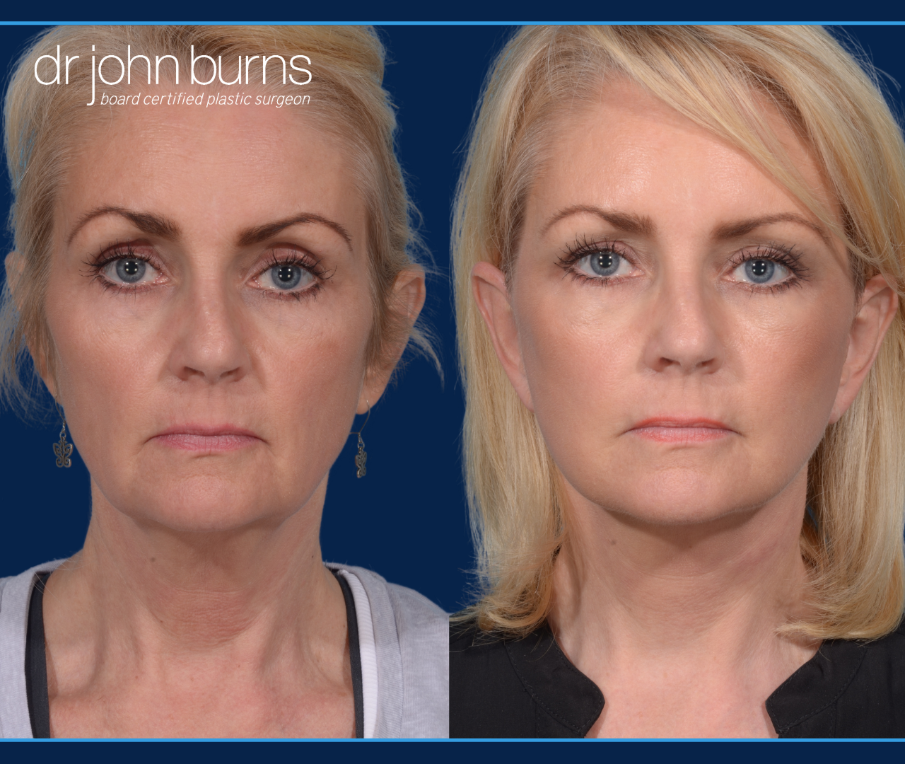 Before and After Dallas Mini Facelift by Dr. John Burns