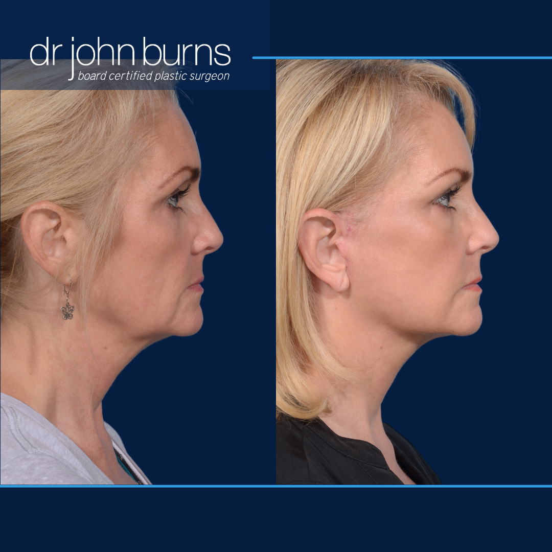 Before and after mini deep plane facelift by Dallas plastic surgeon, Dr. John Burns