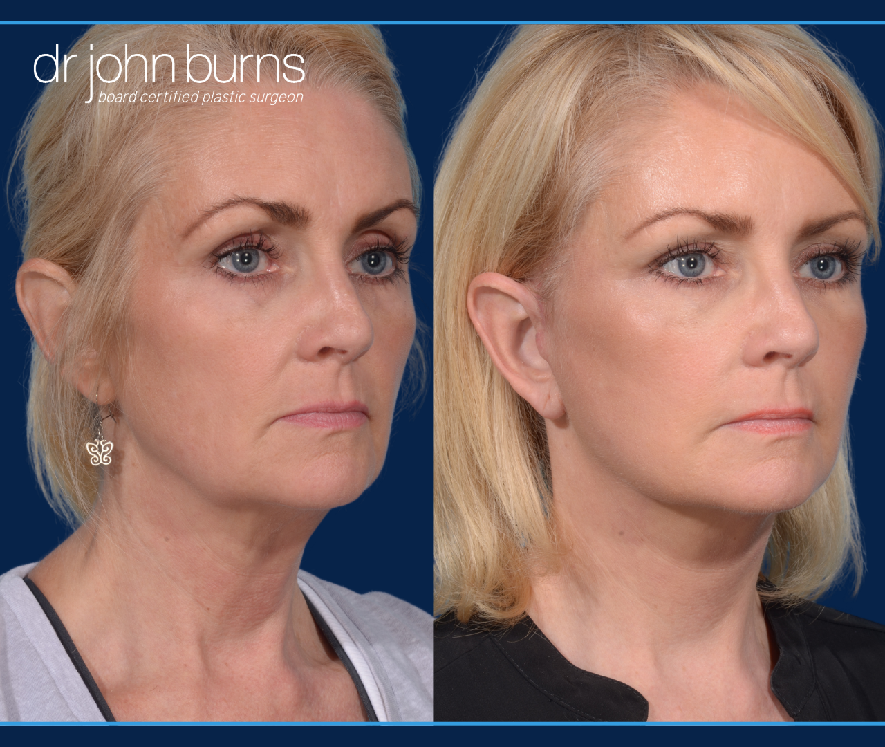 Right 45 Degree View | Before and After Dallas Mini Facelift by Dr. John Burns
