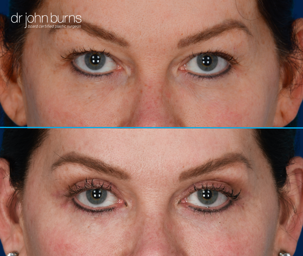 Upper eyelid before and after by Dr. John Burns