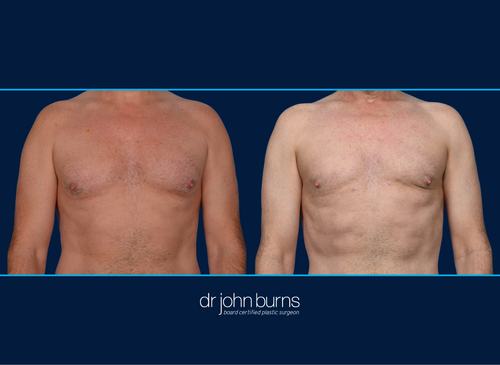 Before and After Male Chest Liposuction | Dallas, Liposuction
