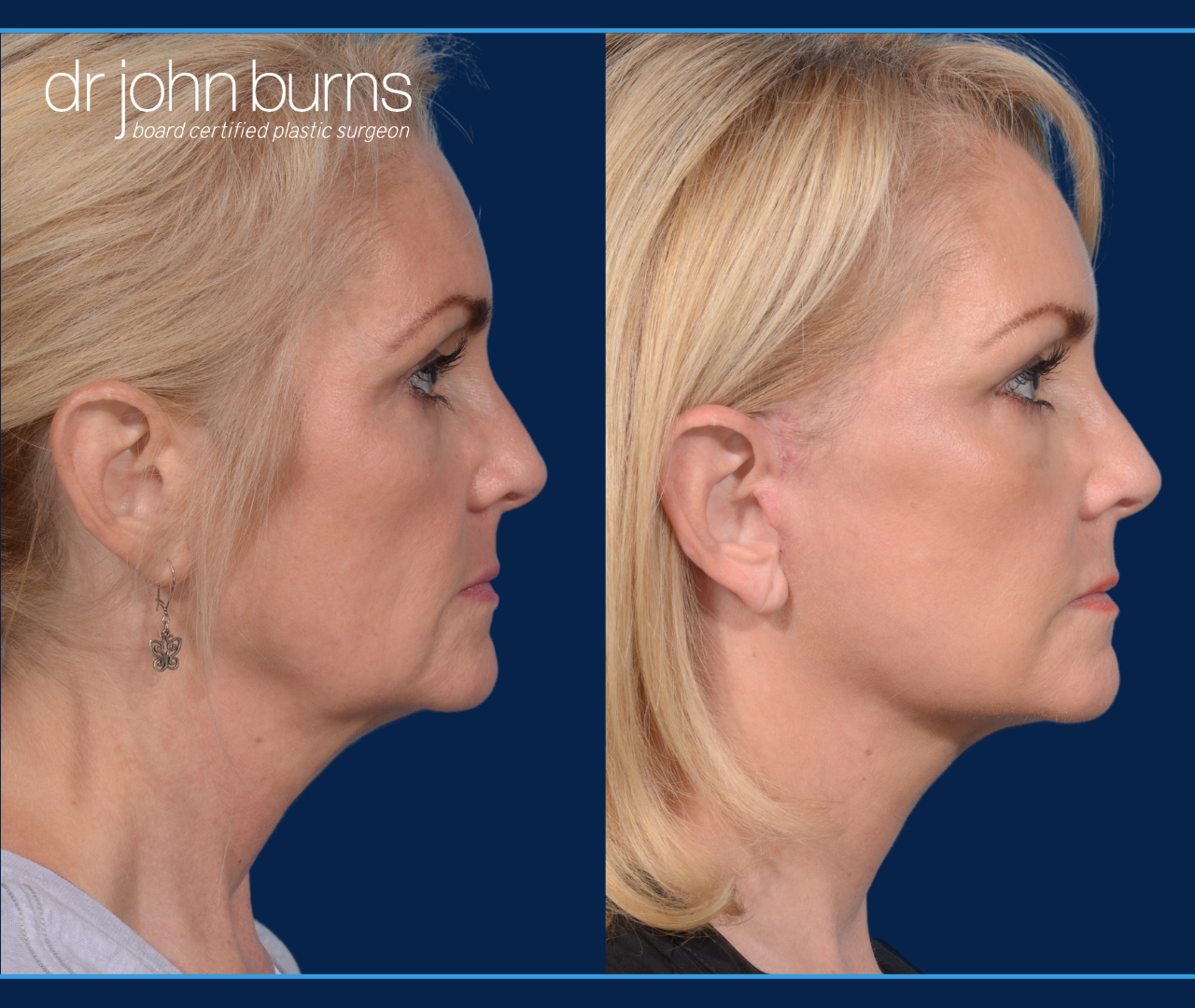 Profile View | Before and After Dallas Mini Facelift by Dr. John Burns