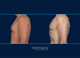 Left Profile View | Before and After Male Chest Liposuction | Dallas, Liposuction