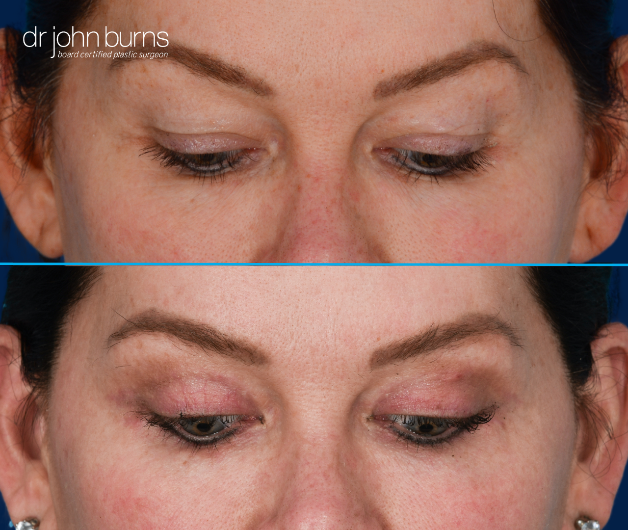 patient looking down, upper eyelid before and after results