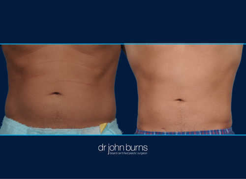 Male Liposuction Before and After | Dallas Ab Lipo by Dr. John Burns