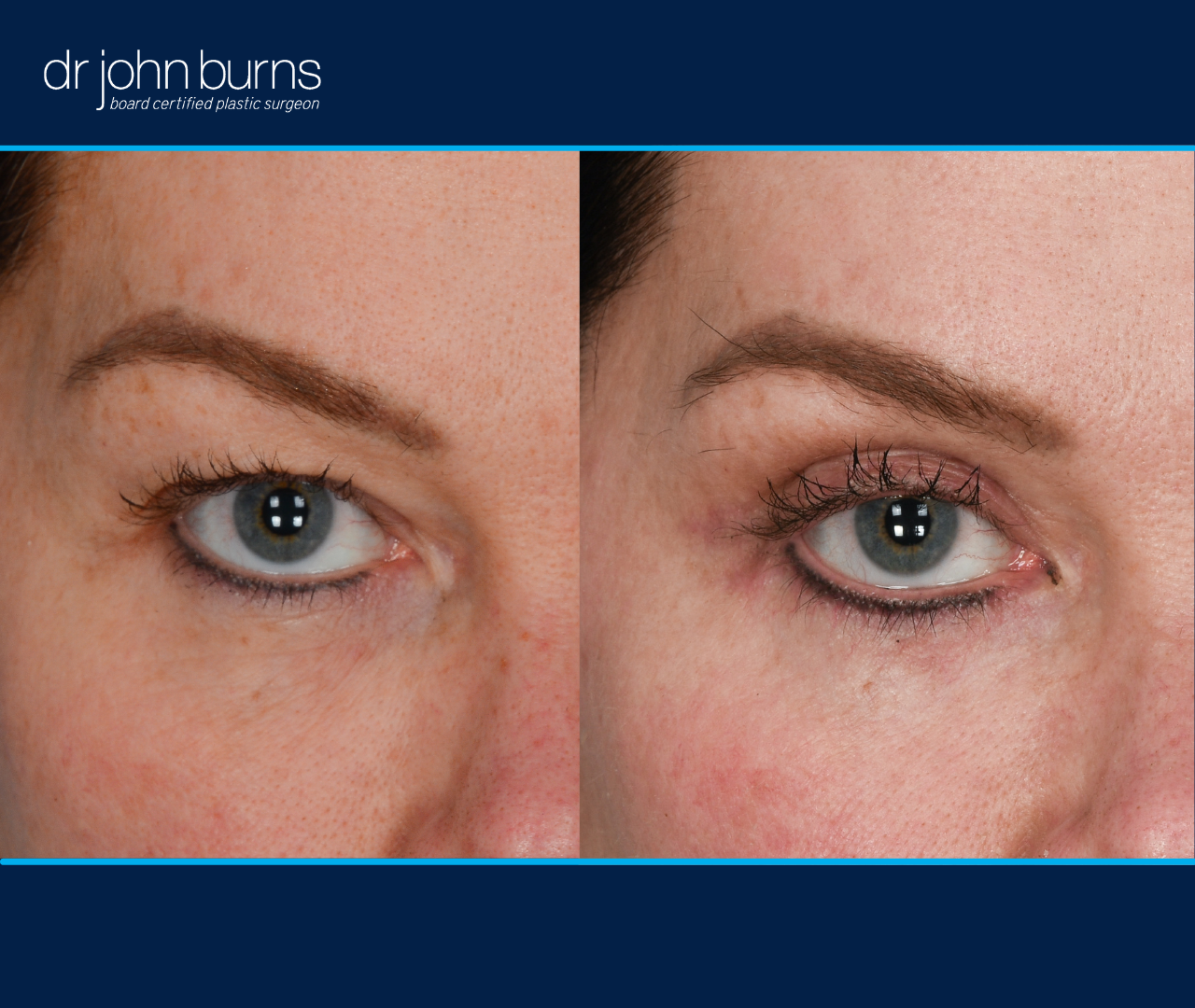 right eye view | before and after eyelid surgery results by Dr. John Burns