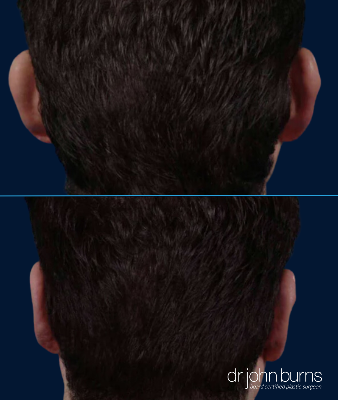 Male Before and After Otoplasty (Posterior Scalp) ear correction by Dr. John Burns