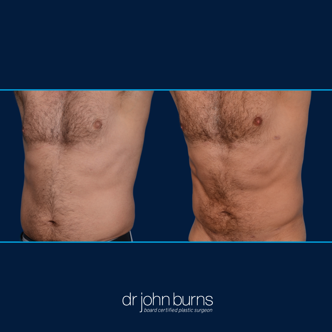 dallas male lipo before and after to chest, abs, and love handles by Dr. John Burns