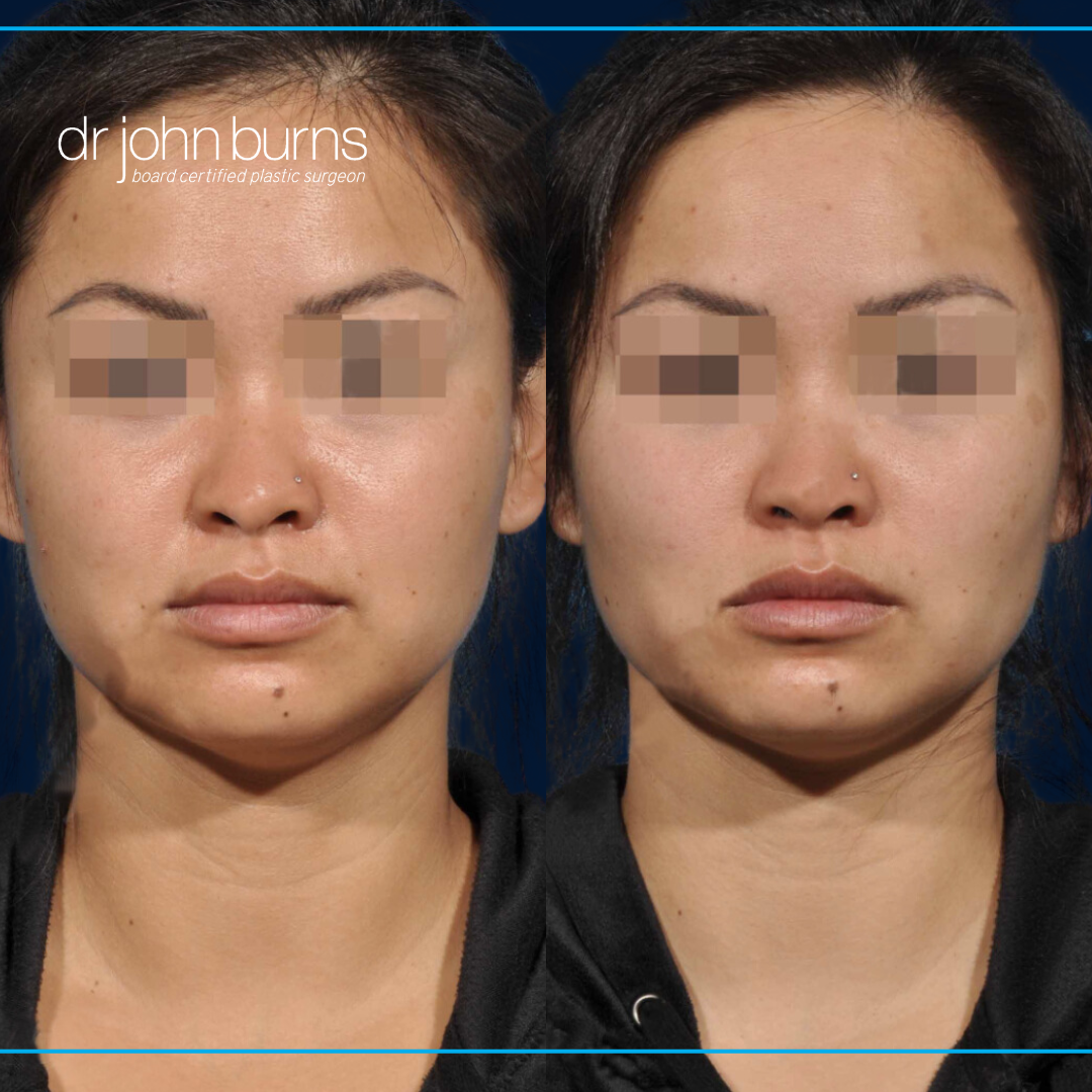 Before and after Buccal Fat Removal