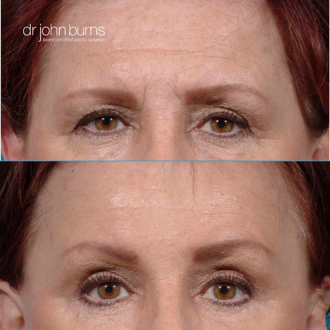 Dallas brow lift before and after results by Dr. John Burns