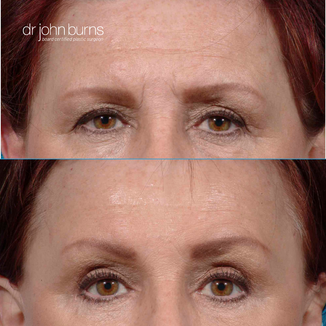 before and after brow lift by Dallas plastic surgeon, Dr. John Burns