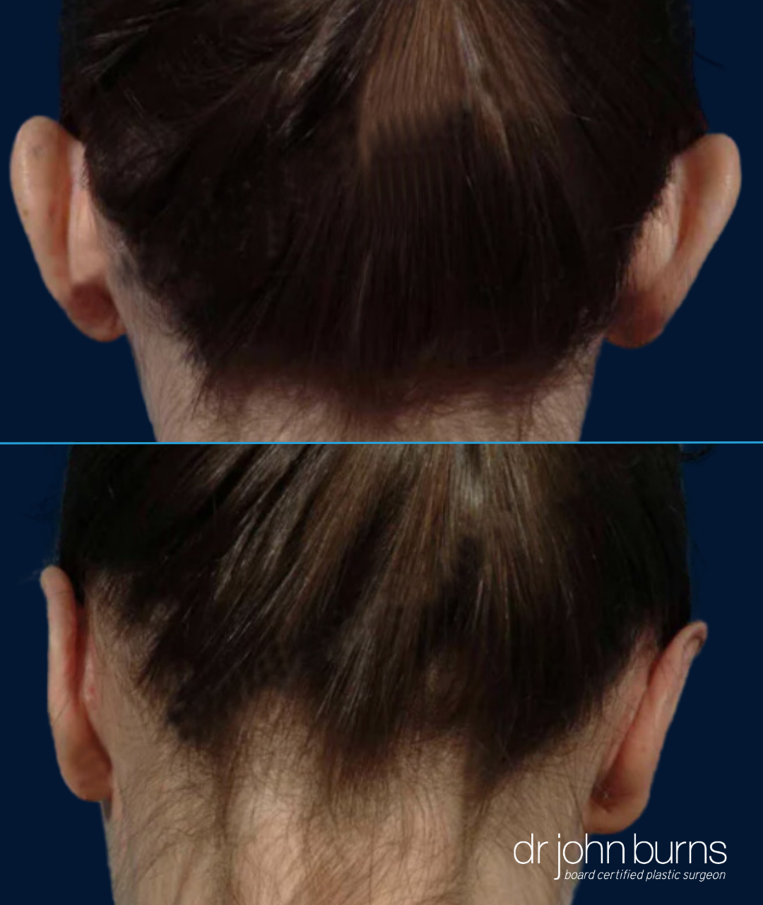 Female Before and After Otoplasty (Posterior Scalp) ear correction by Dr. John Burns